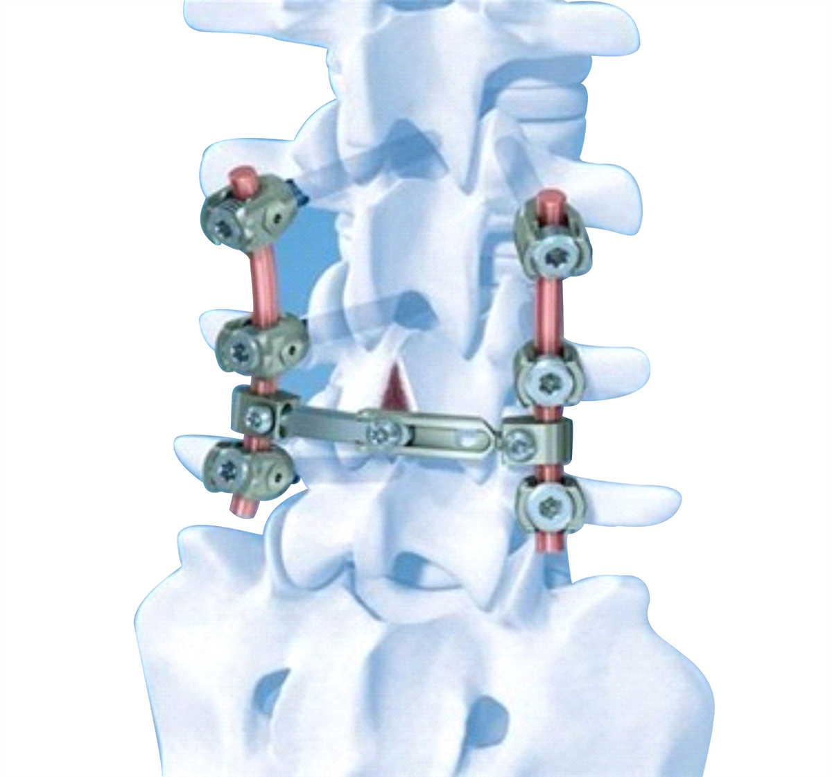 Antibacterial corrosion resistant stainless steel for medical use